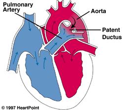 - Patent ductus arteriosus; in which a considerable portion of the blood goes from the aorta into the pulmonary trunk through this opening instead of going to the tissues, so it will keep circulating