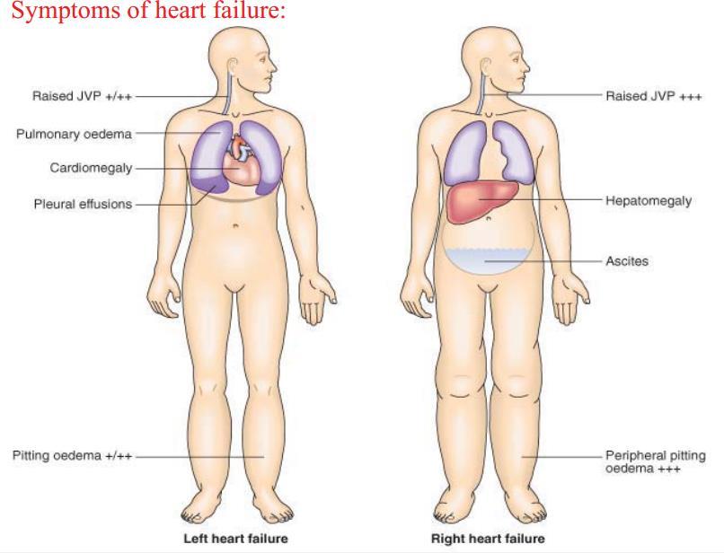 Sometimes, both, right-sided and left-sided heart failure, are developed together in this case it s called congestive heart failure: It starts with left ventricular failure high pressure in the left