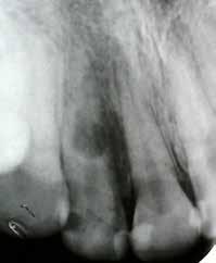 Case Report A 22-year-old female patient was referred to the Department of Endodontics, Shiraz School of Dentistry for management of tooth 7 by a general dentist.