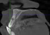 Periapical radiographic examination using a parallel technique revealed a round radiolucency in the middle third of the root with radiolucency in the adjacent bone.