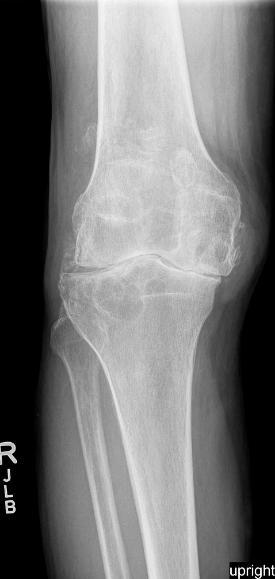 Brian P. McKeon MD Jason D. Rand, PA-C, PT Patient Information Sheet: Total Knee Replacement This is a general information packet for patients undergoing Total Knee Replacement.