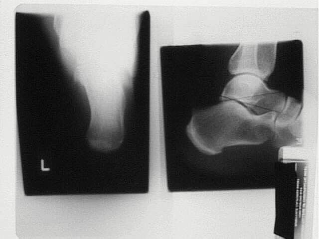 Calcaneus Lateral Film The calcaneus, talus and ankle should be demonstrated in a true lateral position.