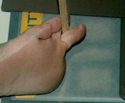 2nd Toe Lateral For individual toes, tape and tongue depressors are used to clear the other toes