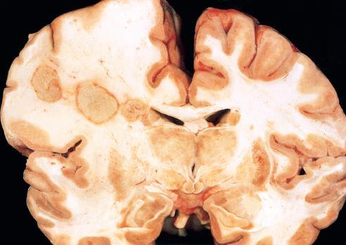 Brain abscess Check http://www.radiologyassistant.nl/en/p47f86aa182b3a/brain-tumor-systematic-approach.