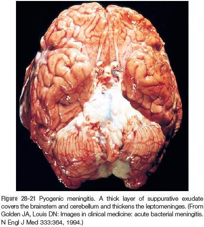Bacterial acute pyogenic meningitis, morphology Elsevier. Kumar et al.