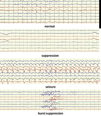 EEG tracing (http://www.ucc.
