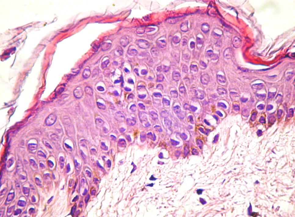 Atypical variant of lichen planus mimicking normal skin histology In our case, there was no distinction between
