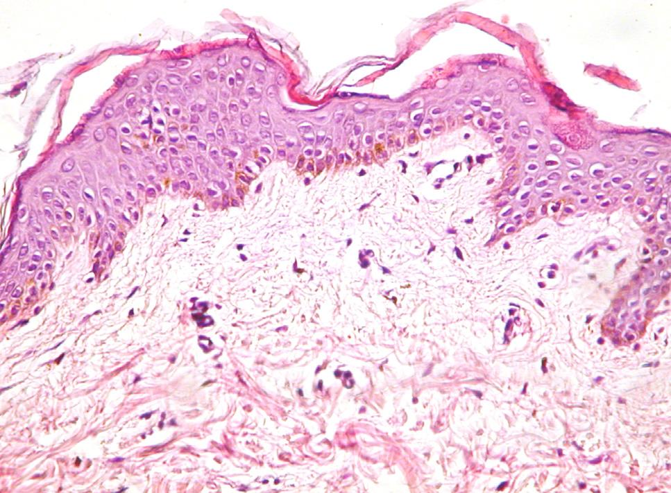 The dermal papillae were flattened and the connective tissue was intensely 1357 stained with eosin.