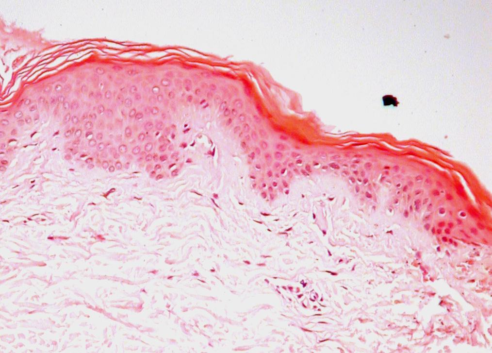 There was a sparse, superficial, perivascular, lymphohistiocytic infiltrate.