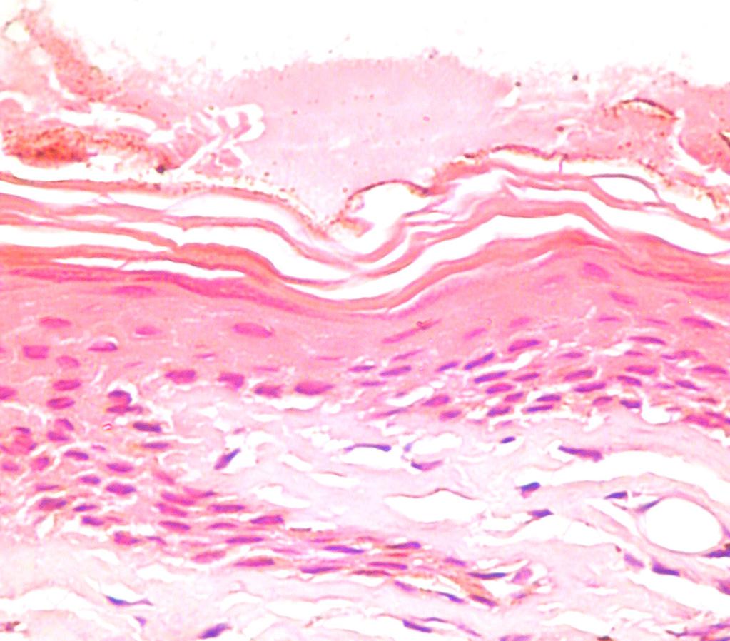 type. Eosinophils were absent in the dermal infiltrate. Figure 1 Granular layer, normal epithelium.