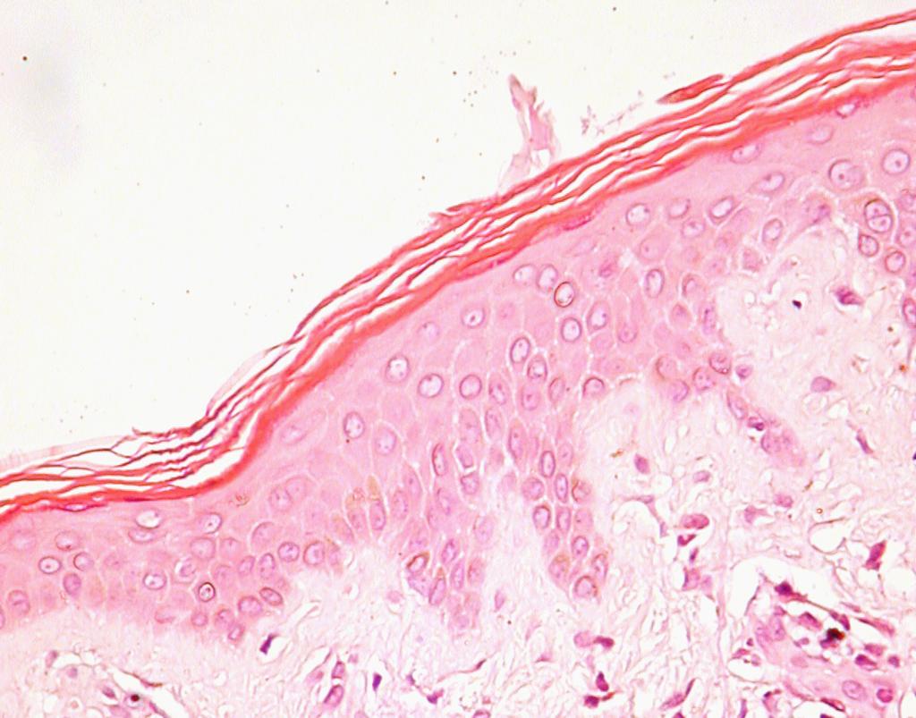 Figure 2 Our case. Increased number of granular cells layers, with slight wedge-shaped hypergranulosis (HE stain, 400 ).