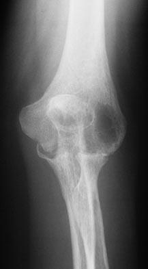 Question 7 A 67-year-old woman with rheumatoid arthritis has had a 3-year history of gradually progressive right elbow pain and limited function