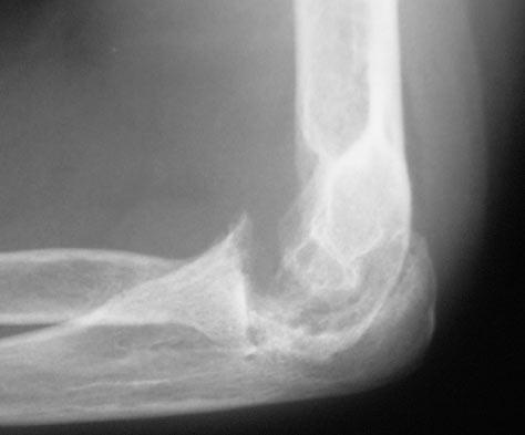 She previously underwent a rheumatoid hand reconstruction, and has no pain or dysfunction of the ipsilateral shoulder.