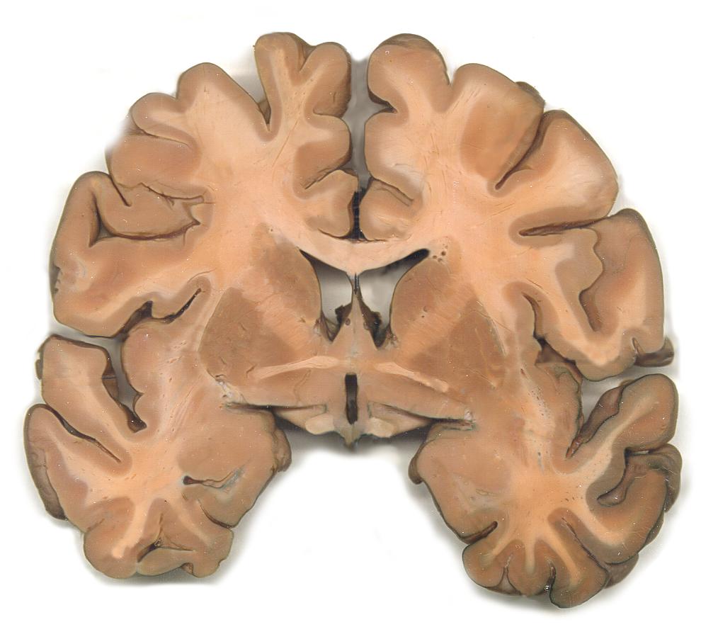 -anterior commissure (temporal lobes) 2. Long association fibers connect different cortical areas on the same side.