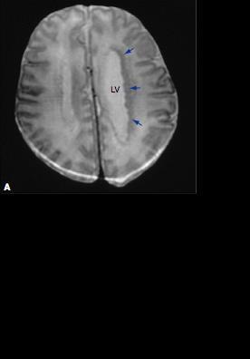 Developmental disorders of the cerebral cortex -Up to 40% of children with drug-resistant epilepsy (chronic