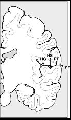 auditory association areas includes Wernicke s area pre-occipital notch lateral fissure central sulcus