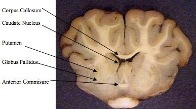 22. Find the putamen, globus pallidus, and caudate nucleus. These structures are collectively known as the Basal Ganglia.