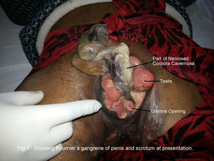 Fig 1 : Showing Fournier s gangrene of penis and