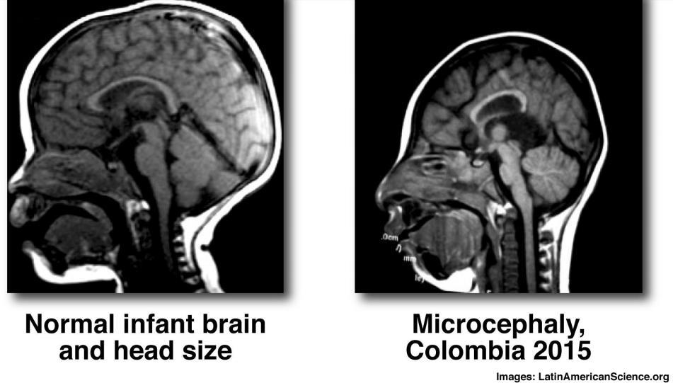 MICROCEPHALY ALSO