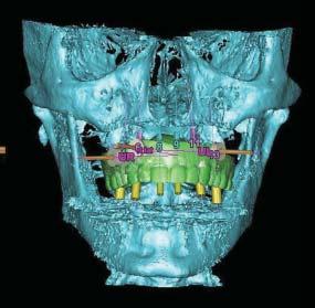 Monolithic zirconia? EMax on CAD abutments? A review of today s current implant restorative materials.