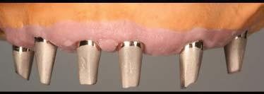 Fixed Implant Prosthetics and Immediate Loading How to categorize the three types of fixed implant prostheses based on tissue volume loss and how