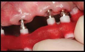 When connecting implants to teeth is clinically acceptable and what is the best method for long term success.