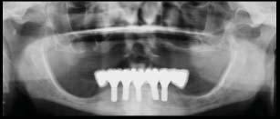 Develop an occlusal philosophy to manage the single tooth implant, quadrant, complete arch and double opposing complete arch fixed implant