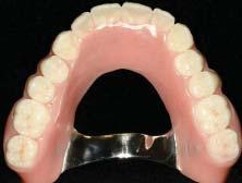Removable Implant Prosthetics and Overdentures When should you plan an