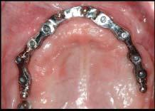 How to determine how many implants are necessary for an overdenture in the