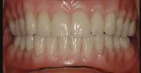 concept of final tooth approval in wax prior to superstructure design and how