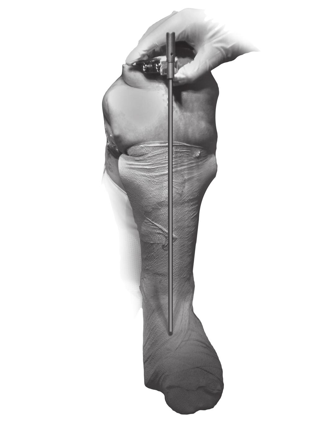 A When fixating the Cut Guide, excessive force from screws can alter the planned location and could influence the amount of varus/valgus in the cut. TECHNIQUE TIP 2.