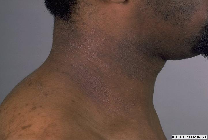 Eczema on dark skin More difficult to assess