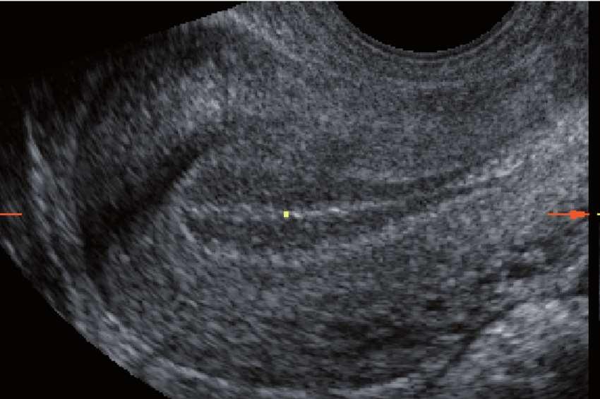 Trilaminar appearance of endometrium