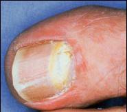 Rubrum that invades the nail through the proximal nail fold, penetrates
