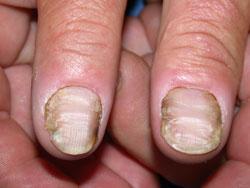 Candida species may invade nails previously damaged by infection or trauma.