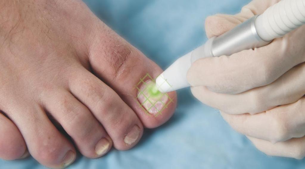 Treatment technique - Guidelines Use a painting motion to uniformly cover the nail with multiple passes in a grid pattern.