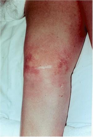 Gardner Diamond syndrome Following the injection of the