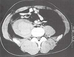 CT scan showing large