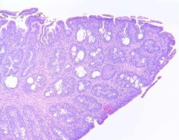 Thymus and Bursa Lymphocyte Depletion Bursa Lymphocyte