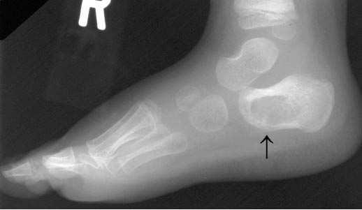 Osteomyelitis (32 m) with a history of