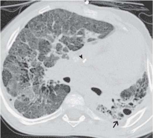 CT scan: 1.severe volume loss 2.honeycomb pattern ( ) 3.