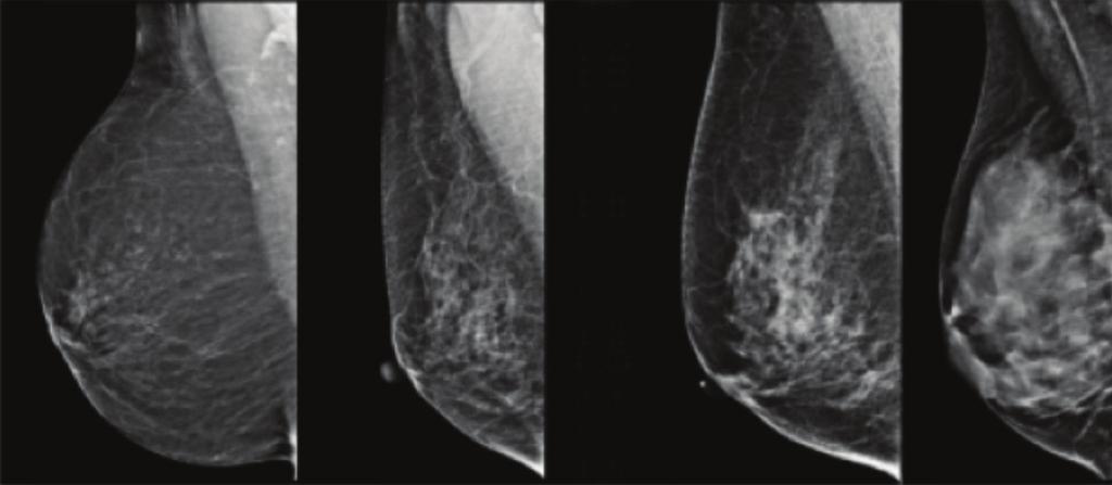 What is this Booklet About? This is a guide to help you understand breast density and how it may affect you. Having dense breasts is very common.