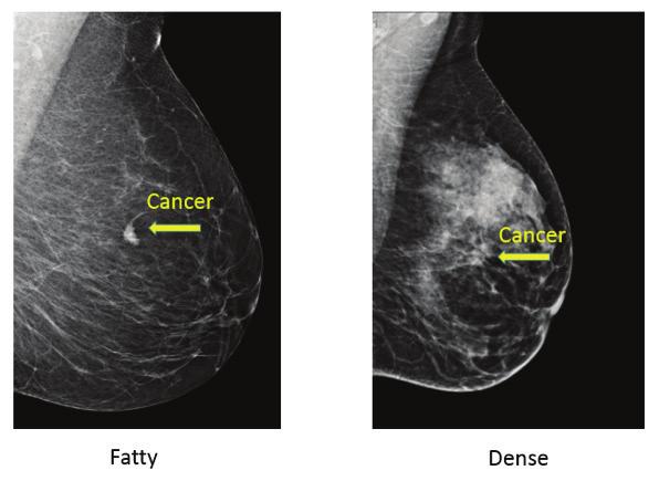 breasts can also make it more difficult to spot cancer on a mammogram. tissue can show up as white on a mammogram, the same colour as many kinds of breast cancer.