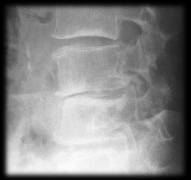 Radiographic evaluation Diagnostic criteria for rheumatoid spine lesions (plain x-ray