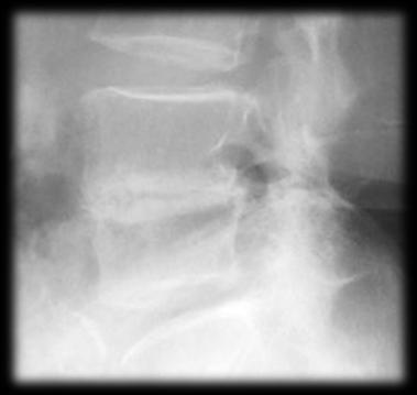 narrowing + vertebral deformity 2 disc space narrowing + erosive endplate 2 irregular