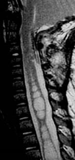 lined by ependyma Syringomyelia: Cavitary lesion within cord parenchyma, of any cause