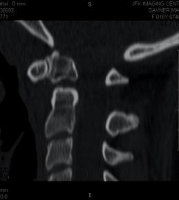 Epidural hematoma Cord avulsion without fracture (0.