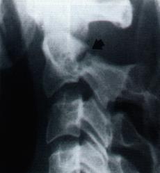compression Bilateral fracture of both anterior and