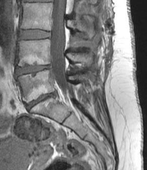 the middle lumbar spine, normal adjacent