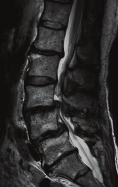 [2] showedamassivethoracicherniation caused by repeated adjacent instability of the thoracolumbar spine after lumbar fusion.